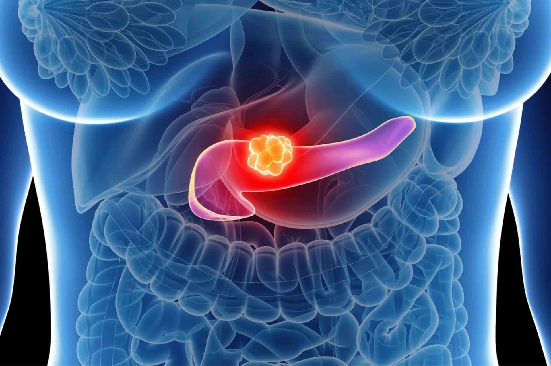 Ανάρρωση από Παγκρεατίτιδα: Συμβουλές για Γρήγορη και Ασφαλή Επιστροφή στην Καθημερινότητα