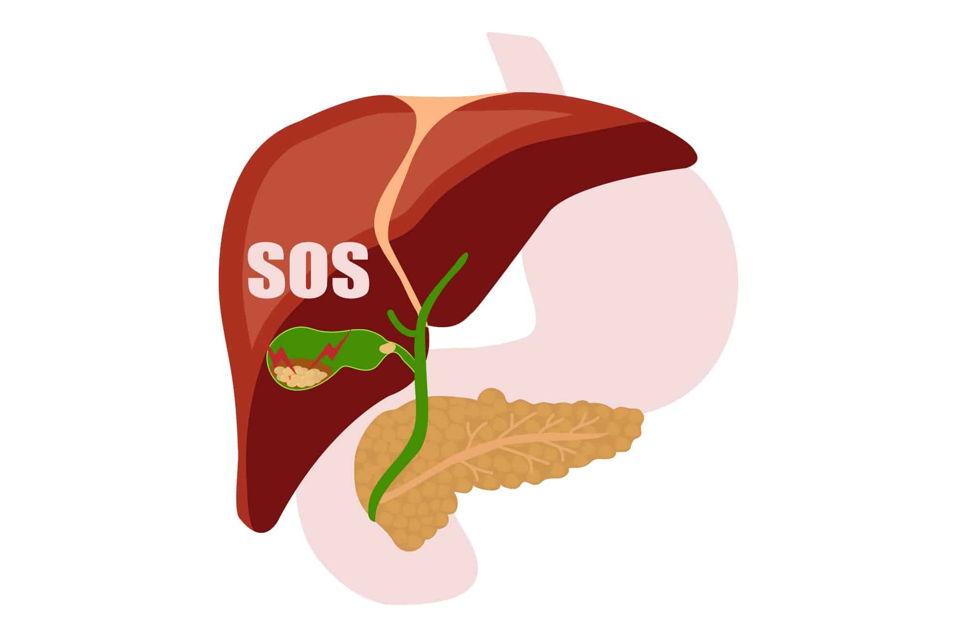 Διατροφικές Συστάσεις για Χολολιθίαση